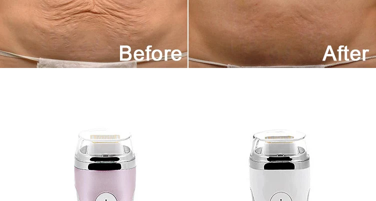 Радиочастотное удаление морщин для лица антивозрастной подтяжки кожи массажер для лица перезаряжаемое устройство для похудения устройство для снижения веса