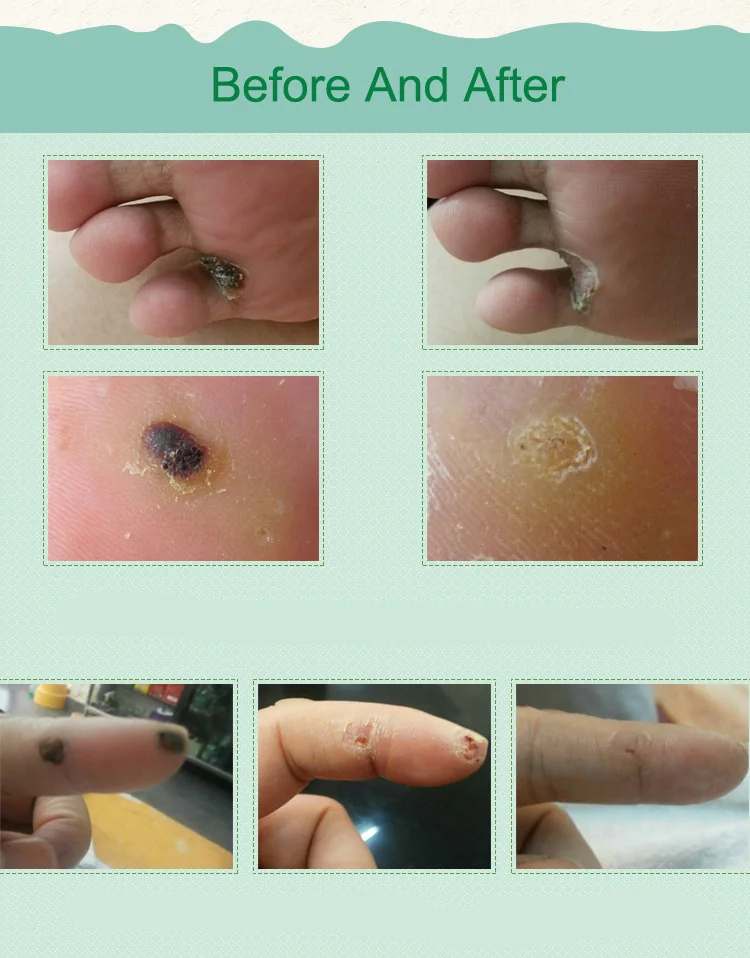 10 шт. медицинские пластыри для ухода за ногами|health care|medical plastersmedical care |
