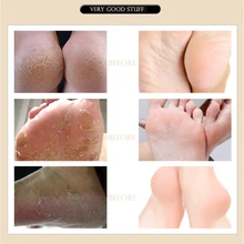 Натуральный травяной отшелушивающий крем для ног против трещин для ног, эффективная противогрибковая омертвевшая кожа, уход за ногами Pro