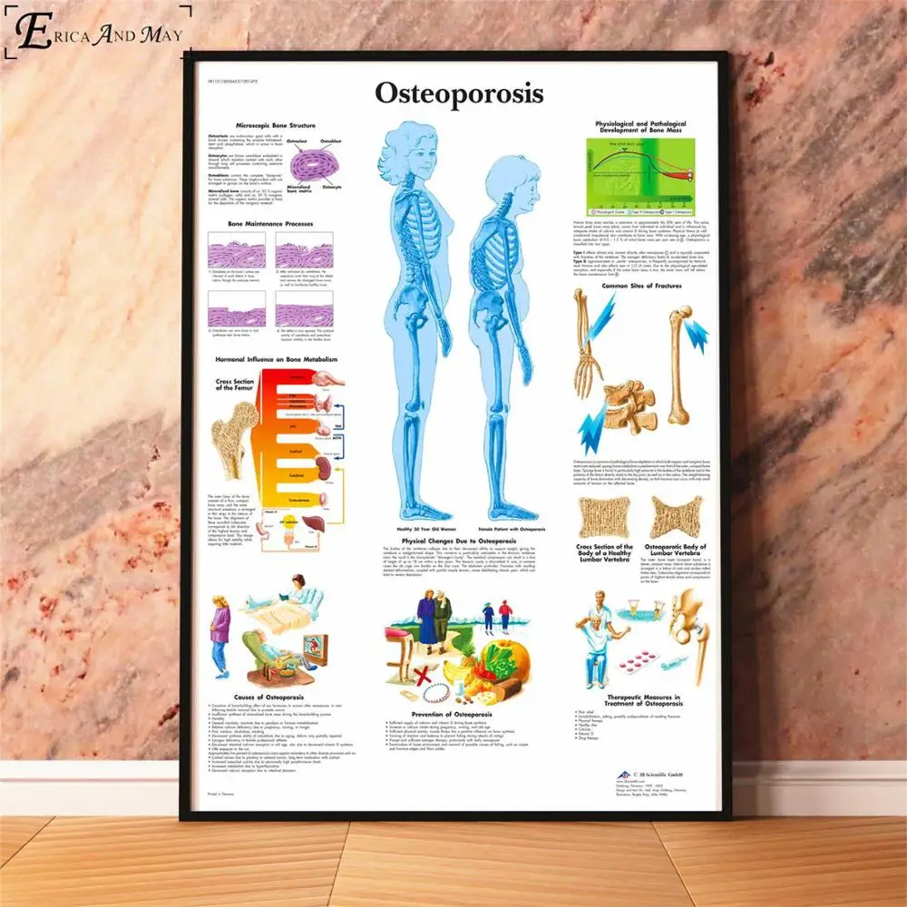 Анатомия болезни патологии диаграмма картина, печатный плакат декоративные настенные картины для комнаты без рамки украшения дома аксессуары - Цвет: Osteoporosis