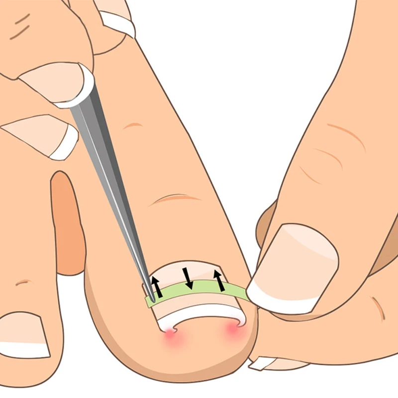 

10pcs/Box Nail Correction Ingrown Toe Sticker Patch Fixer Pedicure Recover Correction File Corrector Foot Care Toe Nail Tool