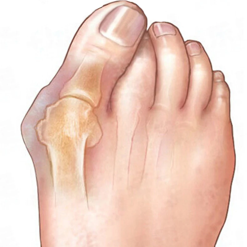 2Pcs/Pair Toe Seperator Foot Care Tool Silicone Gel Big Toe Bunion Thumb Pedicure Orthopedic Hallux Valgus Corrector