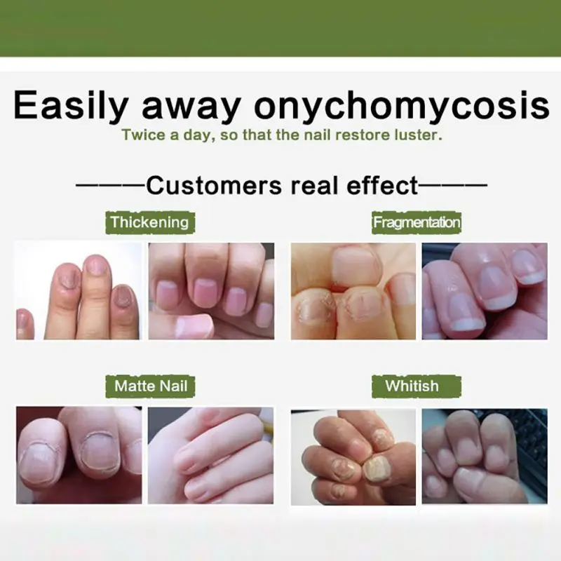 Fungal Nail Treatment Essence Nail and Foot Whitening for Cuticle Oil Toe Nail Fungus Removal Nail Care Makeup