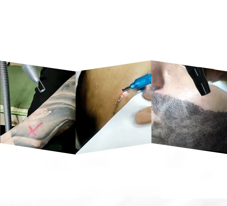 Picosecond Q-switch ND Yag лазер/машина для удаления татуировок/лазерное удаление татуировок