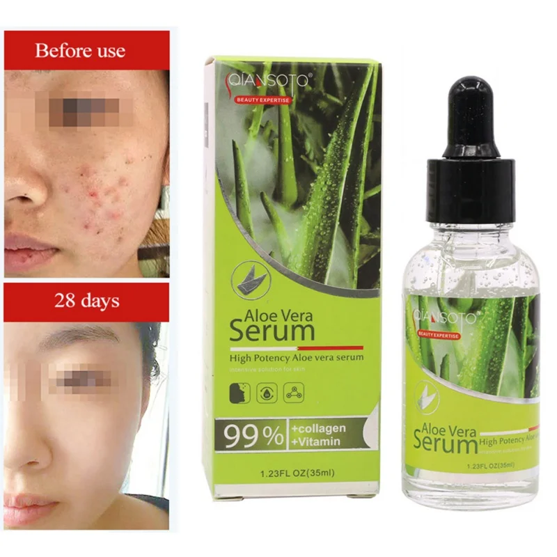 

Pigmentation Corrector Whitening Cream Natural Aloe Acne Treatment Essence Lotion Face Moisturizing Serum No Harm To Baby
