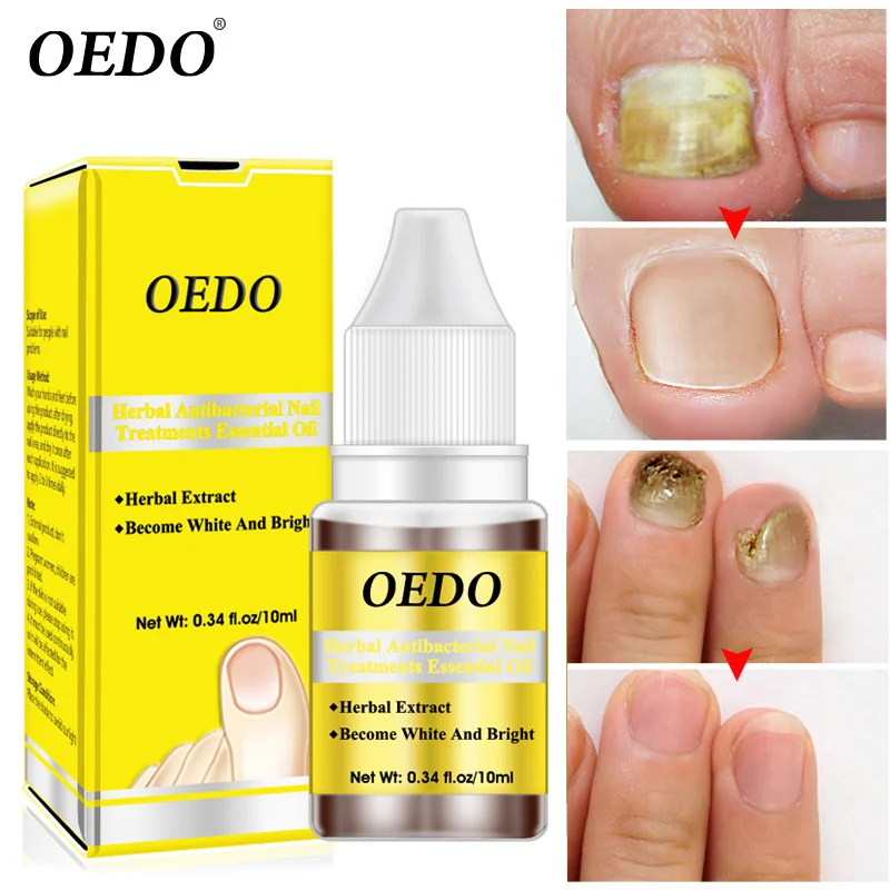 

10ml Ginseng Antibacterial Nail Treatments Essential Oil Nails Fungus Repair Foot Nail Care Onychomycosis Repair Essential Oil