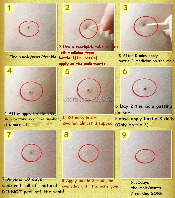 Оригинальный китайских лекарств спекл веснушки Кротов бородавки удалить воды спекл веснушки бесшовные капли воды кожи метки удаления крем