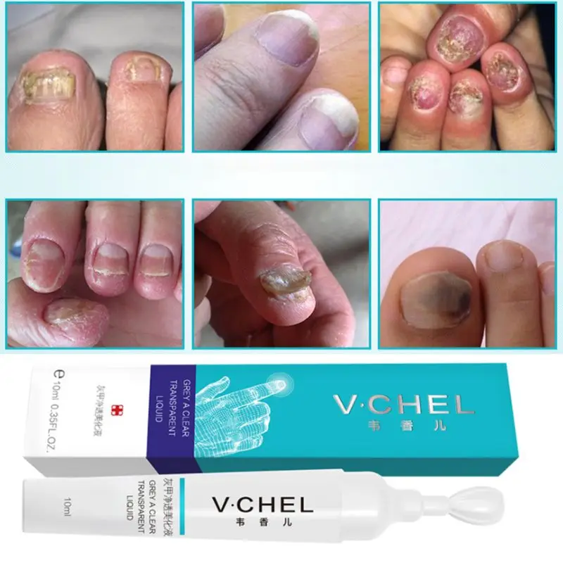10ml Fungal Removal Toe Nail Infection Treatment Pen Gel Essence Bright Pencil Feet Care Anti Fungus Biological Repair Tool Nail Treatments Aliexpress Can i use a coupon in the clearance section of your shop? aliexpress