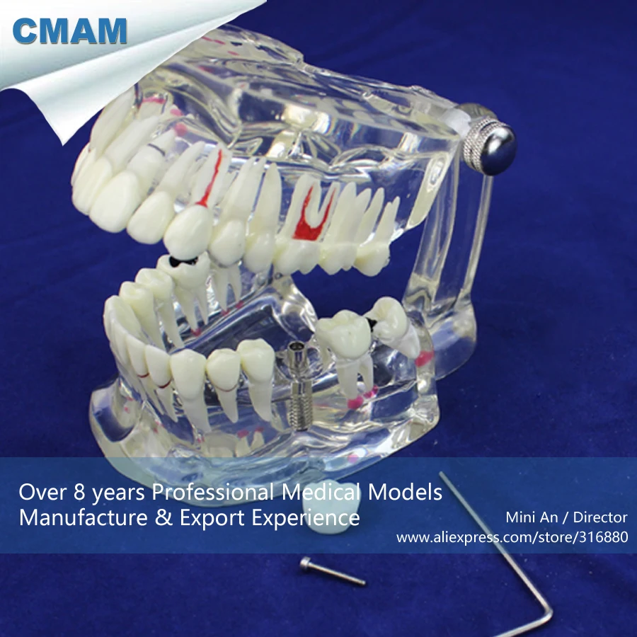 12567 / CMAM DENTAL08 Life Size Transparent Dental Model with Implant