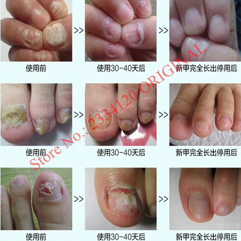 Individualiteit Uitsluiten Pat Kruiden Schimmel Nagel Behandeling Essentie Teen Nagel Vinger Anti Schimmel  Infectie Nail Behandeling Verwijdering Nail Care Lotion|fungal nail  treatment|fungal nail treatment essencenail treatment essence - AliExpress