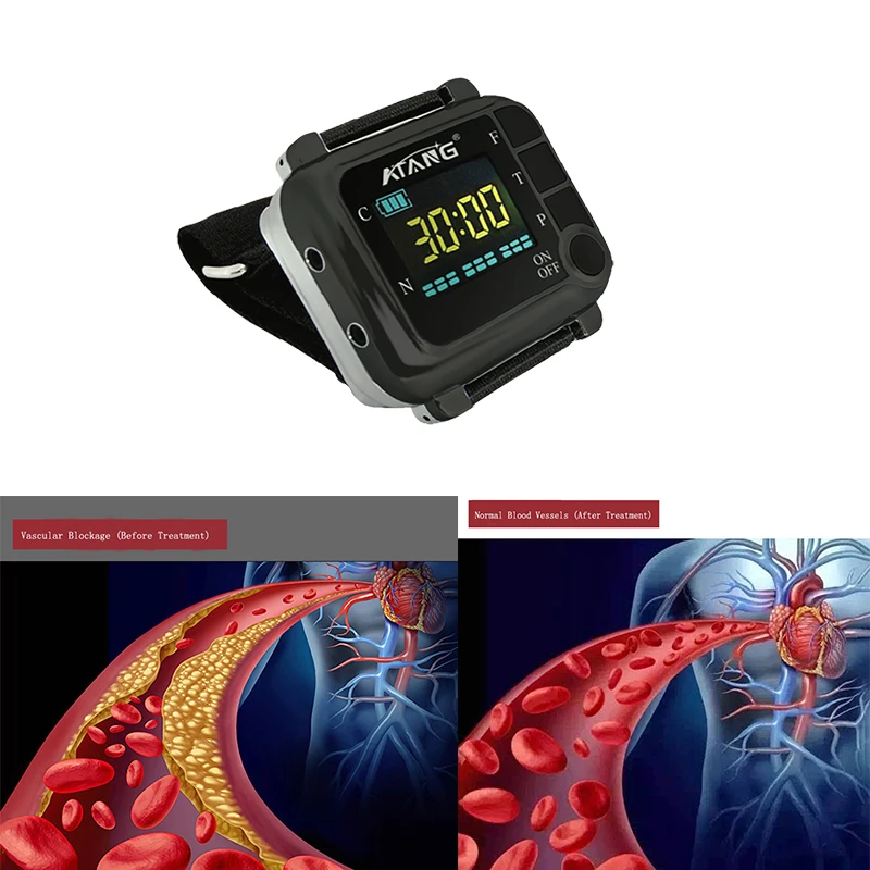 

CE Laser Physiotherapy 650nm Laser Light Wrist Diode Low Level Laser Therapy lllt for Diabetes Hypertension Diabetic Watch