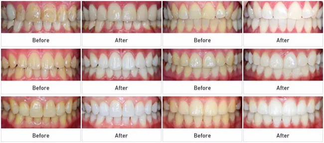 Зубное оборудование FDA Стандартный отбеливание зубов 44% система отбеливания пероксида гигиена полости рта уход гель комплект отбеливатель зубов