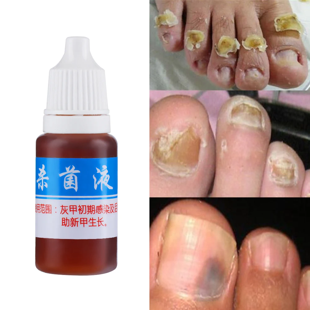1 бутылка Лечение ногтей от грибка жидкость яркий ремонт ногтей Onychomycosis эссенция для удаления анти-инфекция Уход за ногами 5 мл