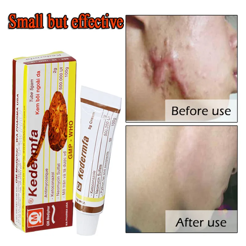 

Kedermfa Skin Scar Erasing Cream snake oil for skin Acne Scar Removal Cream anti-inflammatory Skin Care Pigmentation Corrector