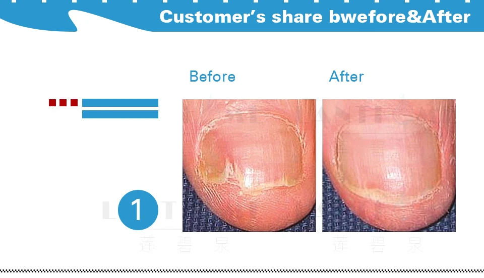 Дропшиппинг травяные грибковые ногти лечение ног удаление грибка ногтей гель Уход за ногами эссенция для ногтей Отбеливание ног яркий анти-инфекция