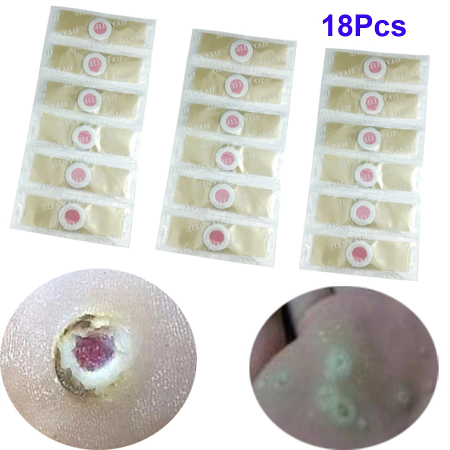 

18pcs Medical plaster Foot Corn Removal Remover Warts Thorn Plaster Of Calluses Patch Callosity Detox Foot Pads Curative Plaster
