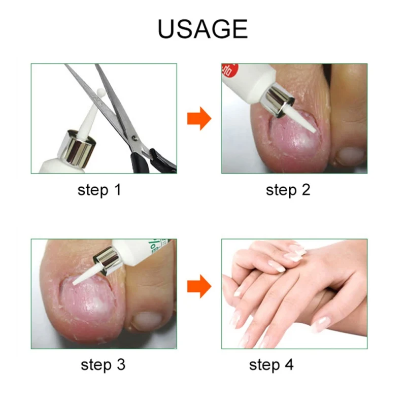 Средство для лечения грибковых ногтей, отбеливание ногтей и ног, удаление грибка, отбеливающий Уход за ногами, гель для ногтей
