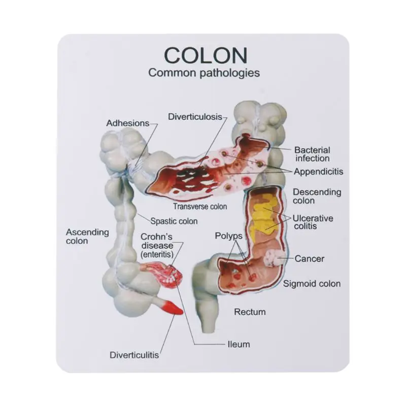 Человека, модель поражения патологическая анатомия Колон заболеваний кишки для медицинской учебной обучающий инструмент