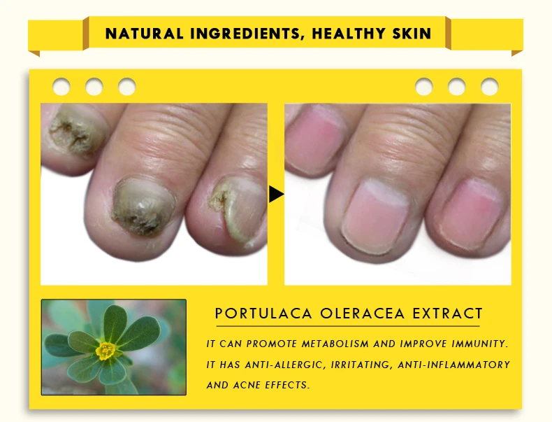 Бактерицидное Натуральное эфирное масло для ногтей, жидкое средство для восстановления ногтей, удаление грибка пальцев ног, увлажняющее средство для ухода за ногами, 10 мл, TSLM2