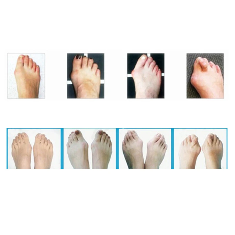 2 пары растяжки для ног при вальгусной деформации|toe separator|toe pedicuretoe toe |