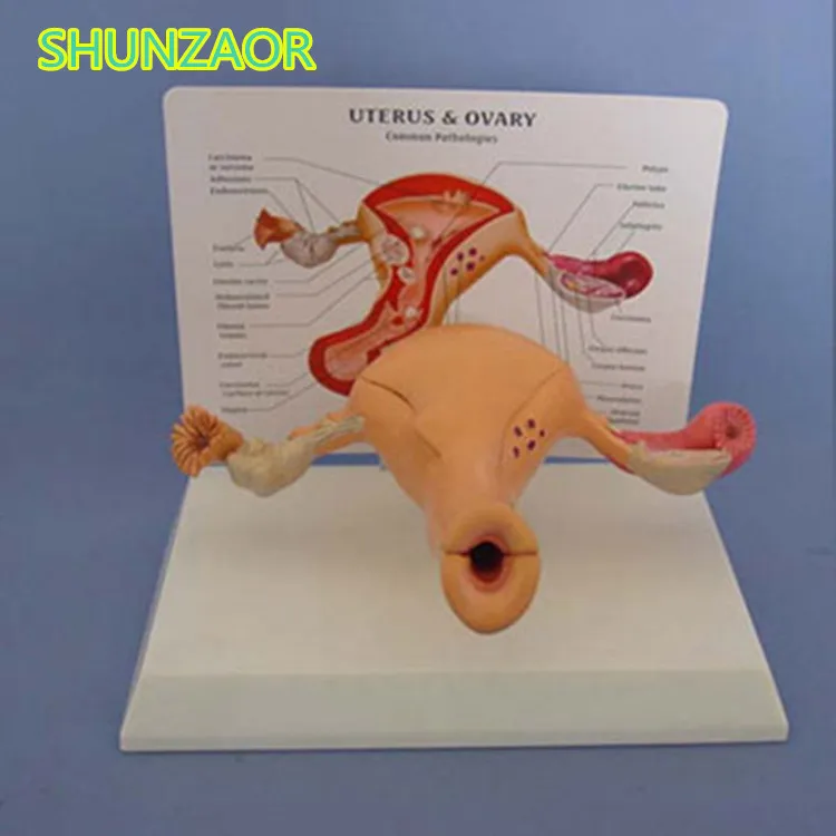 

SHUNZAOR Sick uterine cap model Medical Anatomy Model Teaching Model