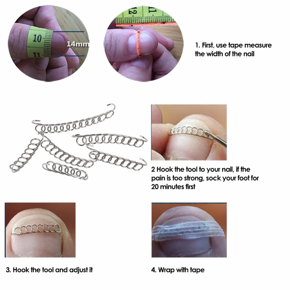 Одна пара пружина+ инструмент фиксатор педикюр восстановление Уход за ногами инструмент для коррекции ногтей acronyx проволочный корректор для пальцев вросших ногтей