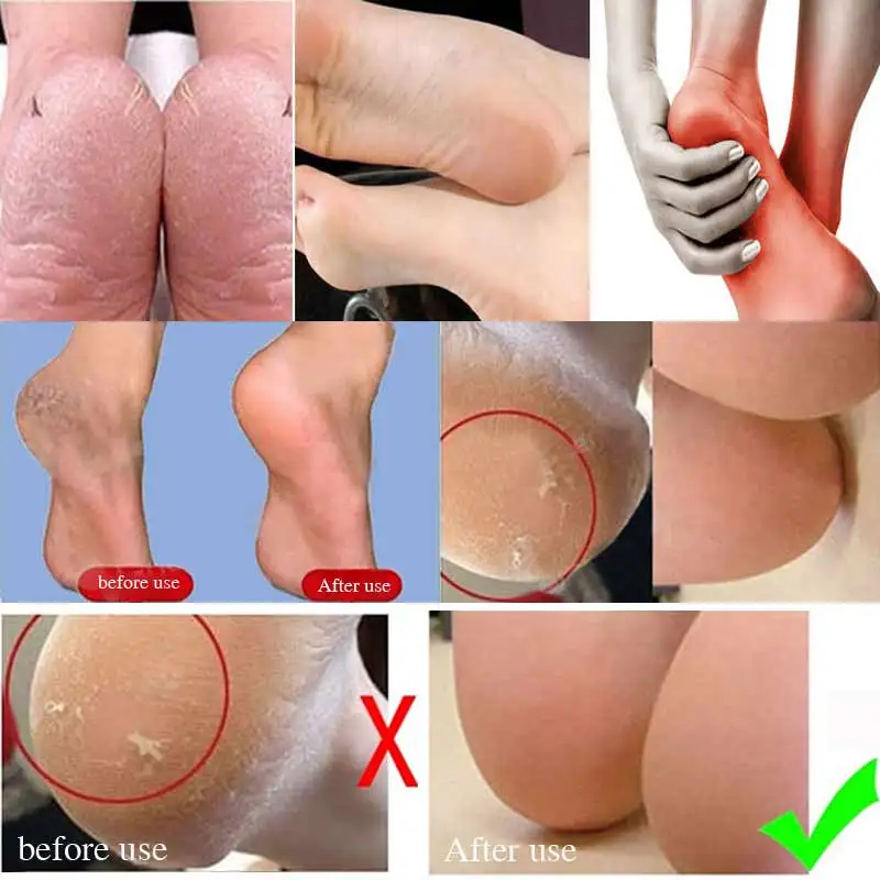 Cuidados com a Pele Plantillas de Ferramenta do Cuidado Rachado para Los Pair Meias Calcanhar Rachada Protetor Silicone Hidratante Pedicure pé Pies 20 Gel 9 Ferramenta do Cuidado Hidratante Pedicure Pé Rachado Para Los Pies