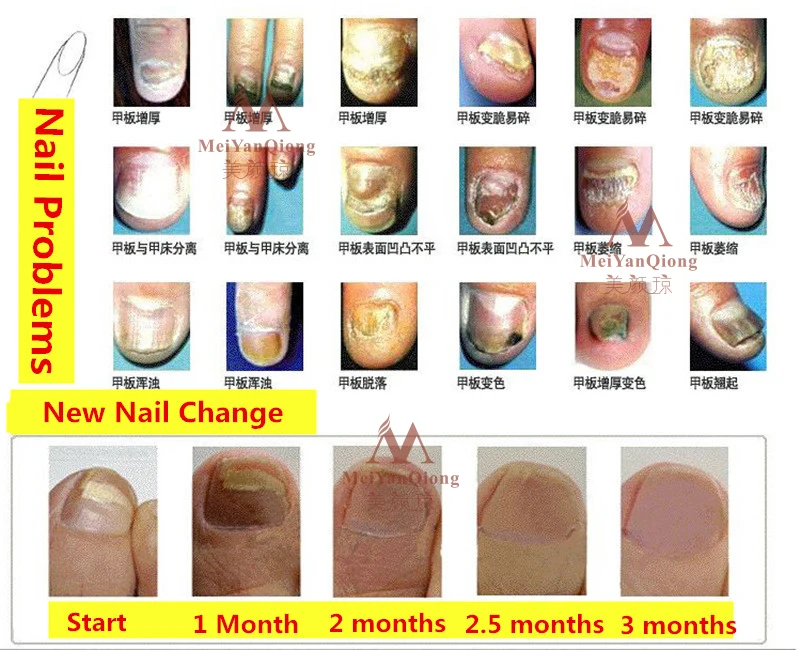 Китайский травяной для лечения Ногтей onychomicosis Paronychia против грибковой инфекции ногтей хороший результат Китайский травяной грибок для ногтей