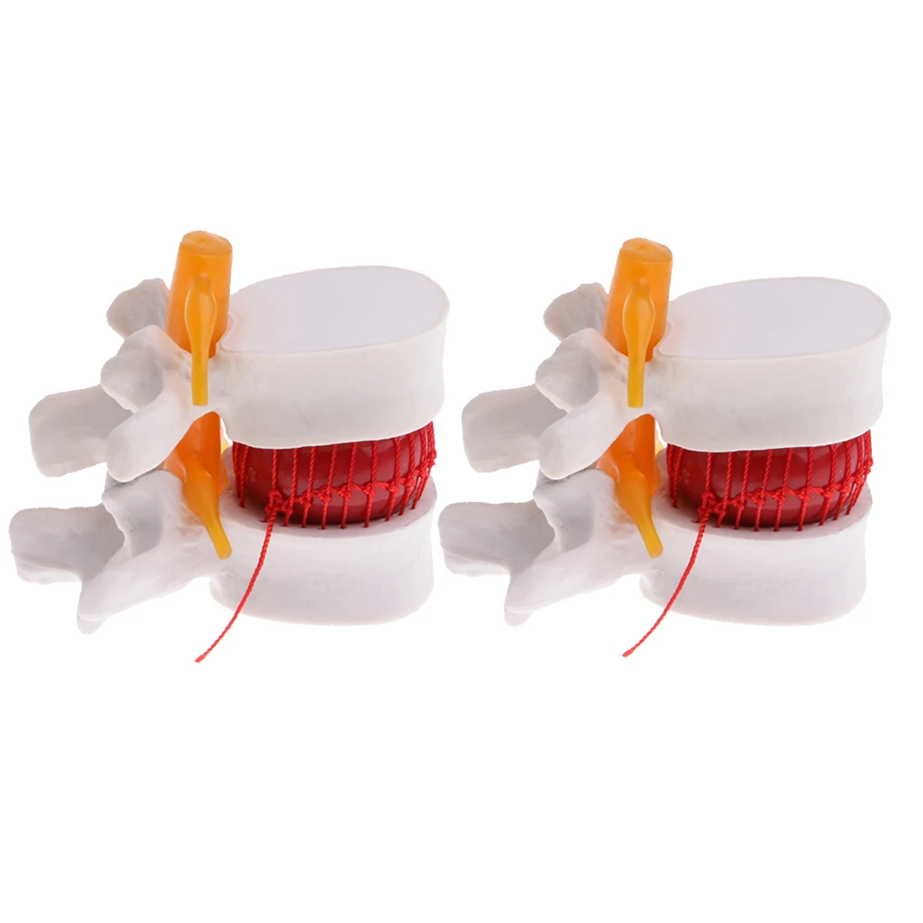 

2PCS Professional Human Lumbar Intervertebral Disc Protrusion Lab Demonstration Display Model Magnification 2x