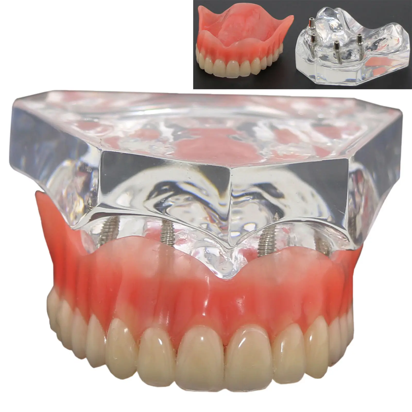 Зубные верхние зубы модель сверхпротез превосходное 4 имплантаты демонстрационная модель 6001 02