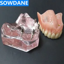 Dental Overdenture Upper Anterior Maxillary with 4 Implants Restoration Teeth Study Teach Model dental implants inmediate loading full arch new concepts