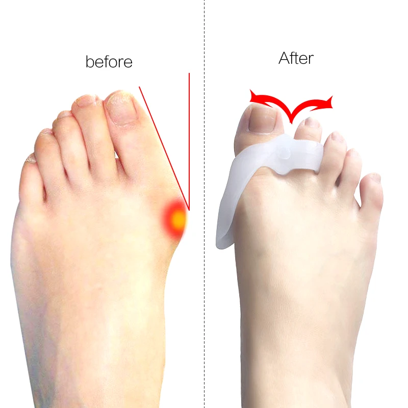1pair Toe Separator Hallux Valgus Corrector Silicone Orthopedic Mats Big Toe Separator Thumb Bunion Corrector Pedicure Foot Care