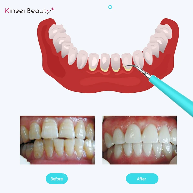 Электрический звуковой стоматологический инструмент для удаления зубного камня от зубных пятен, зубной камень, стоматологический инструмент, отбеливатель зубов, гигиена здоровья, подсветка