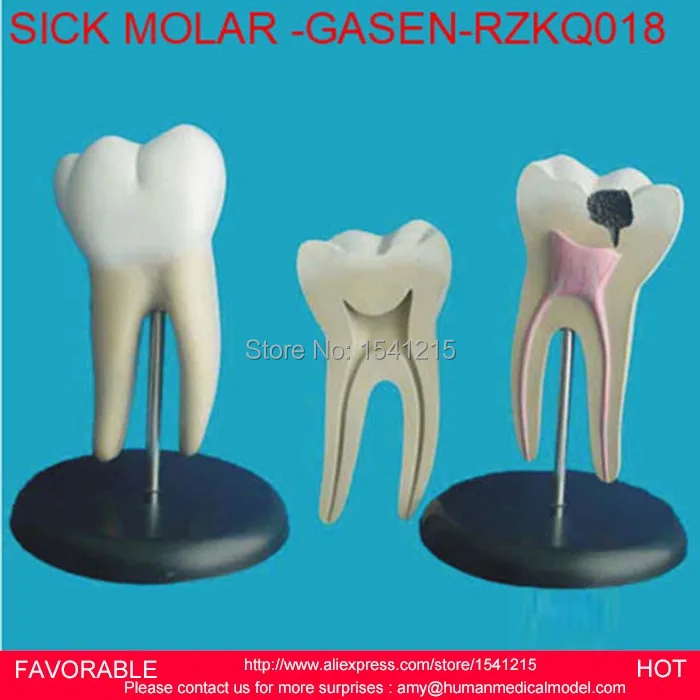 

DENTAL MATERIALS TOOTH PATHOLOGY DISSECTION MODEL DECAYED TOOTH GINGIVAL DISSECTION ,SICK LARGE MOLAR -GASEN-RZKQ018