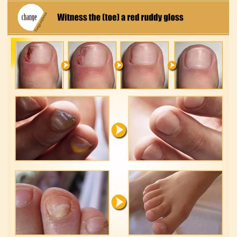 Горячий грибковый гель для лечения Ногтей, отбеливание ногтей и ног, удаление грибка ногтей, уход за ногами, гель для ногтей
