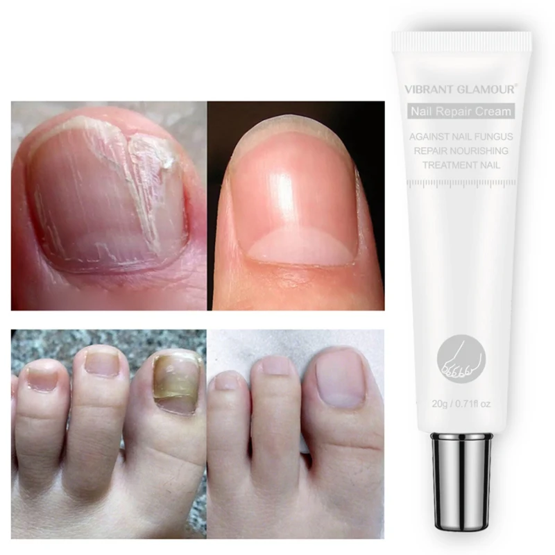 

Recommend 20g Nail Toe Repair Cream Nail Care Nail Repair Cream Nail Fungus Treatment Onychomycosis Removal Anti Fungus