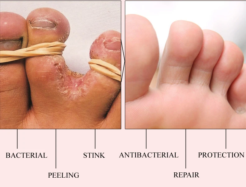 15 г Горячая Уход за ногами противогрибковые инфекционные ноги ремонт травяной крем для снятия берибери лечение