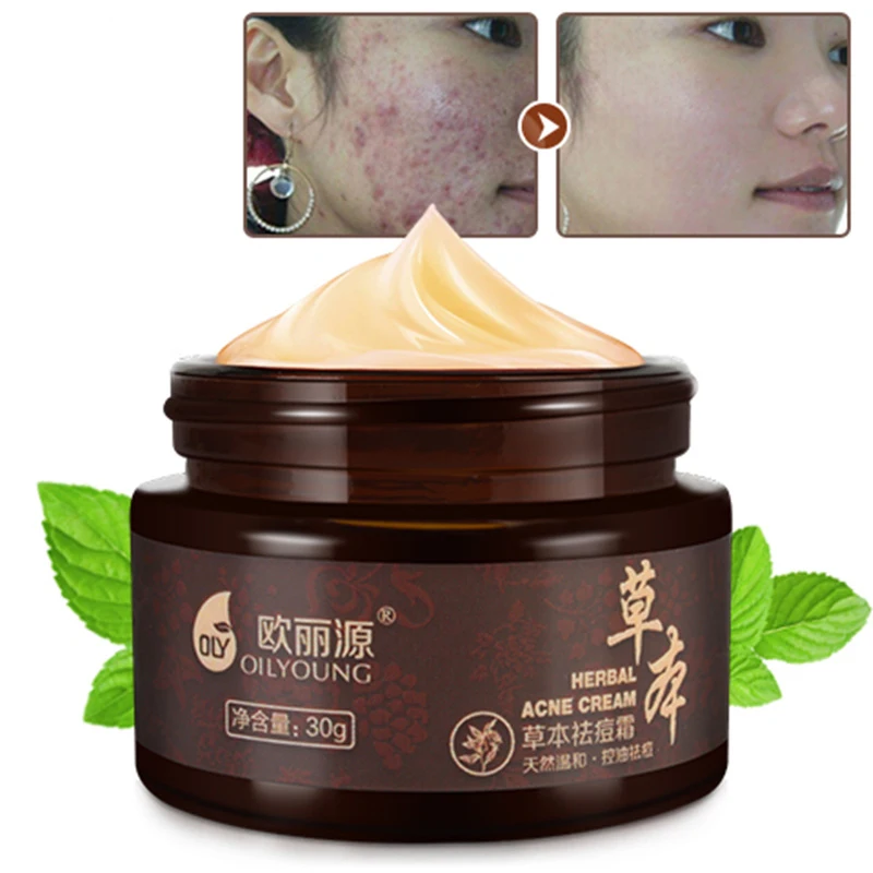 

Herbal Acne Cream Anti Pimple Spot Acne Scars Blackhead Removal Cream Whitening Beauty Skin Face Care Creams Acne Treament 30g