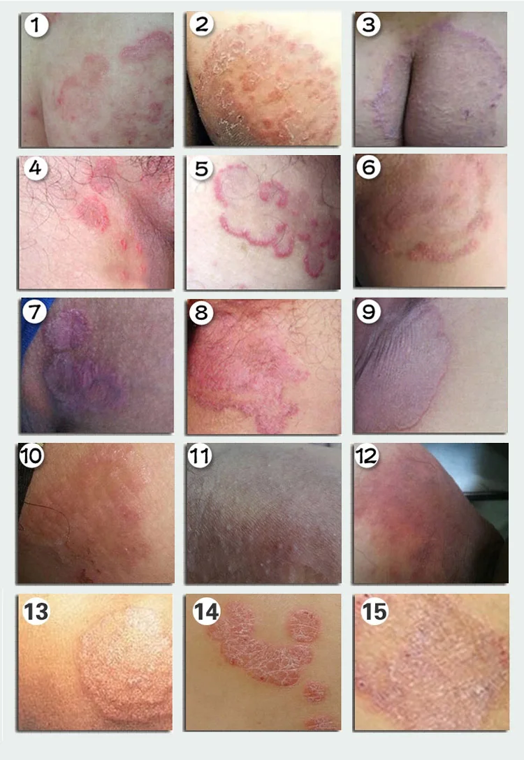 フット乾癬と白癬そう痒症皮膚炎や湿疹漢方クリーム Medicine Arthritis Cream Peep Toe Shoescream High Heel Boots Aliexpress