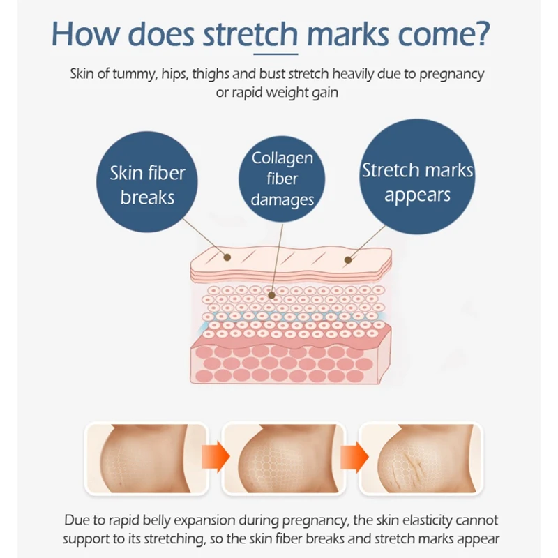 Удалить стрейч Знаки восстанавливающий крем с беременности и родам восстановления кожи шрамы ожирения линии упругость кожи гладкой уход за кожей