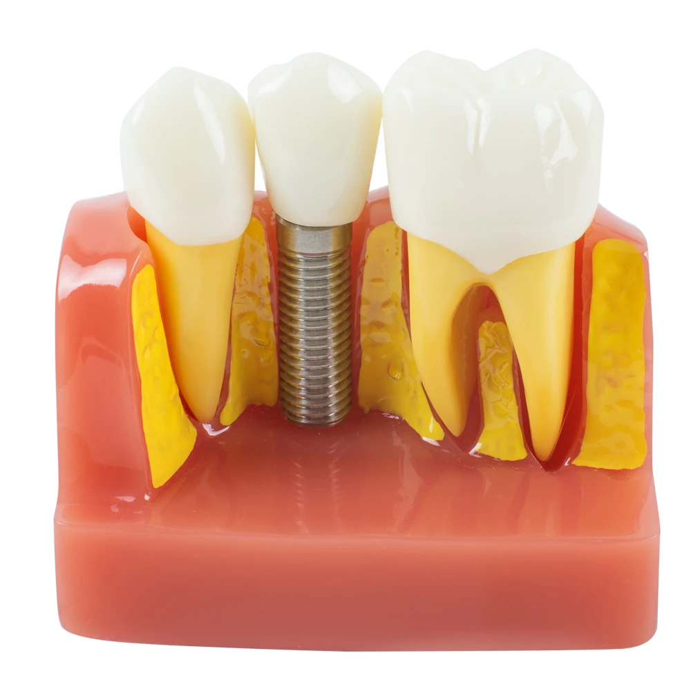 

Professional Dental Demonstration Teeth Model Implant Analysis Crown Bridge