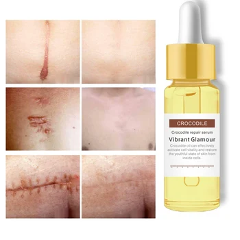 

Crocodile Repair Scar face serum Removal Acne Scar Whitening for Spots Acne Treatment Stretch Marks Skin Care