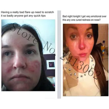 

Rosacea Cream Acne Remover Cream Blackhead Remover Red Nose Ointment Herbal Anti-acne and Mite Acne Cream Acne Treatments