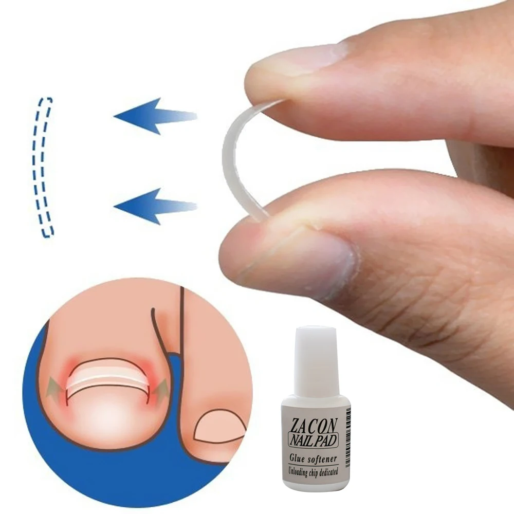 Клей для ногтей Быстросохнущий суперклей для выпрямления ногтей Аксессуары для ухода за ногами