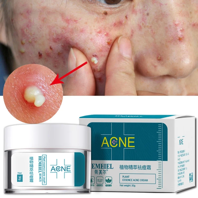

Acne Treatment Face Cream Anti Acne Scar Removal Pimple Blackhead Moisturizing Whiten Oil-control Shrink Pores Skin Care