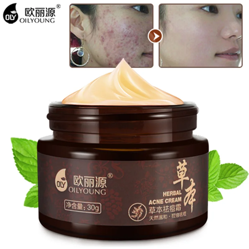 Herbal Acne Cream Anti Pimple Spot Acne Scars Blackhead Removal Cream Whitening Beauty Skin Face Care
