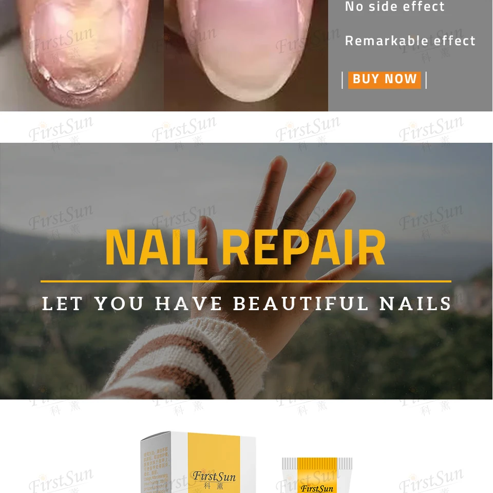 5pcs Nail Fungus Treatment / Onychomycosis Paronychia / Anti Fungal Nail Infection Good Result Chinese Herbal Toe Nail Treatment