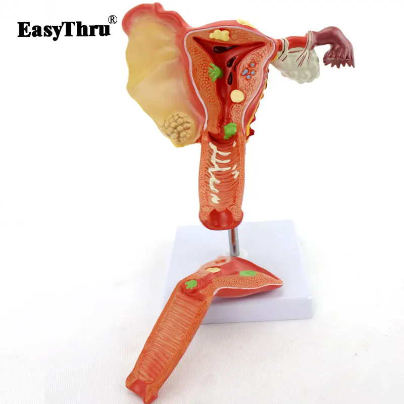 

Female Reproductive system Uterine Ovarian Vaginal Disease Model for Obstetrics and Gynecology traumatic pistol anatomy model