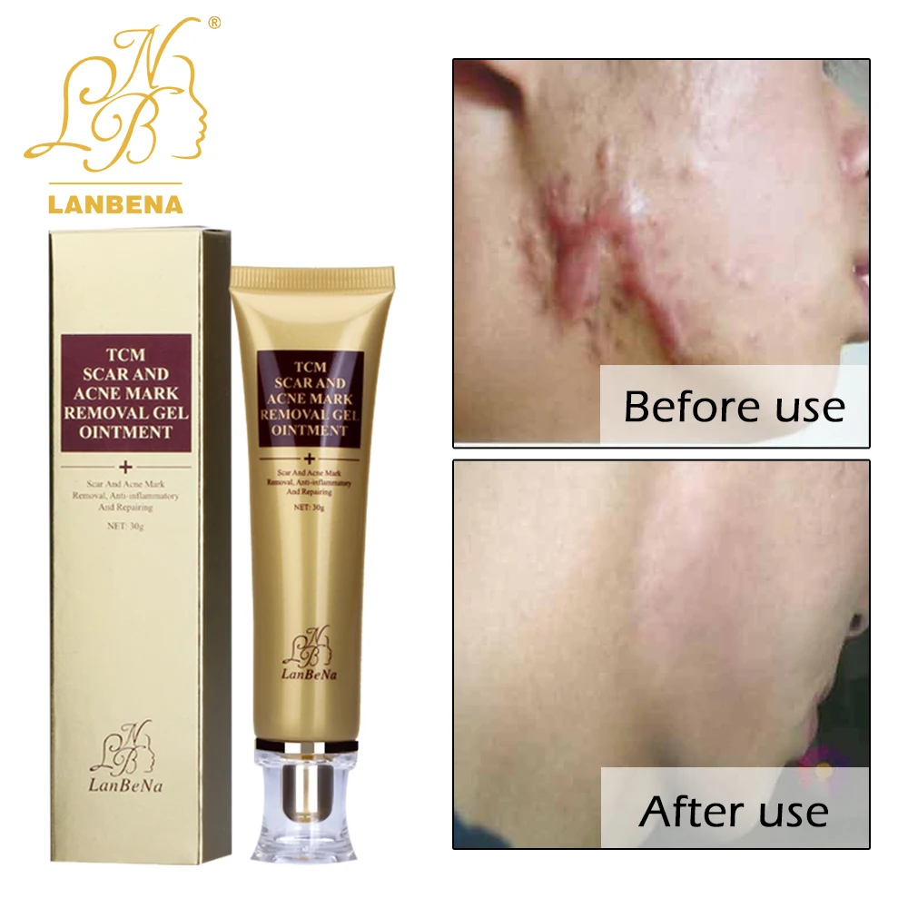

LANBENA Acne Scar Removal Cream Skin Repair Face Cream Acne Spots Acne Treatment Blackhead Whitening Cream Stretch Marks 30ml