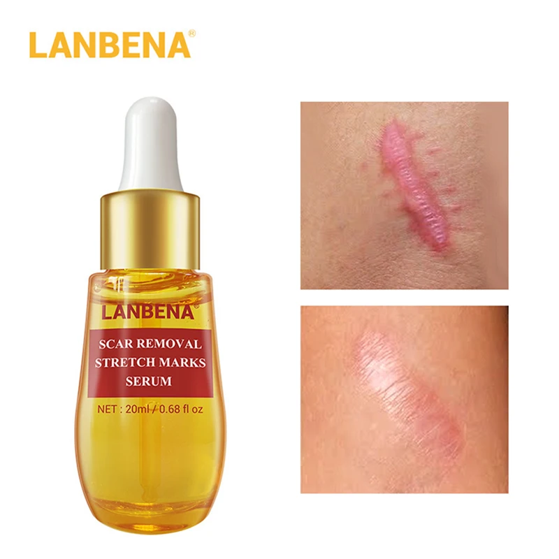 Удаляет рубцы после акне Essence Remover растяжки для очистки пор и отбеливания уход за кожей H7JP